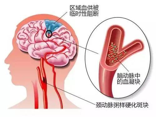 脑梗发作前兆，三个部位可能变硬