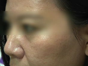女子线雕手术三年后脸上意外出现线雕痕迹——线体自钻而出